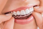 Niềng răng là gì? Những phương pháp niềng răng phổ biến