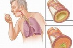 Những người có nguy cơ mắc ung thư phổi