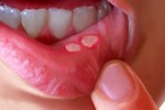 12 cách chữa căn bệnh nhiệt miệng