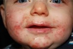 Chủng virus EV71 có nguy cơ gây tử vong ở trẻ