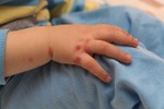 Hương Sơn có 24 trẻ mắc bệnh tay chân miệng