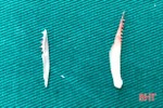 Hãi hùng với 2 xương cá dài 3,5cm trong thực quản 1 bệnh nhân Hà Tĩnh