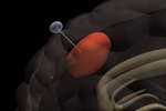 Đột phá thiết bị ‘nhử’ tế bào ung thư khỏi não bộ