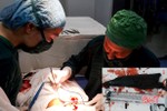 BVĐK Đức Thọ phẫu thuật lấy dị vật 12cm xuyên thủng tay bệnh nhân
