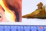 BVĐK Hà Tĩnh gắp xương gà kích thước lớn trong thực quản bệnh nhân