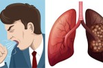 5 dấu hiệu sớm của ung thư phổi