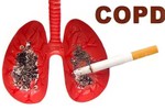 Gần 90% bệnh nhân bị bệnh phổi tắc nghẽn mãn tính có tiền sử liên quan đến thuốc lá