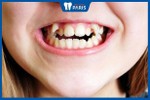 Niềng răng trẻ em: Tất tần tật những thông tin cha mẹ cần biết