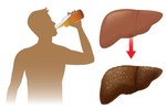 Bệnh gan nhiễm mỡ do rượu là gì?