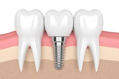 Giải pháp phục hình răng Implant là gì? Giá trồng răng trên thị trường hiện nay