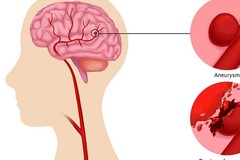 Đau đầu đột ngột coi chừng phình động mạch não