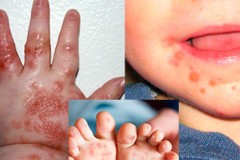 Số mắc tay chân miệng tăng 4 lần, Bộ Y tế yêu cầu phòng chống khẩn